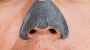 penyebab komedo di hidung terus muncul