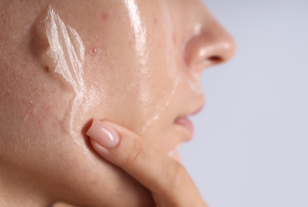 Penyebab kulit mengelupas setalah pakai skincare
