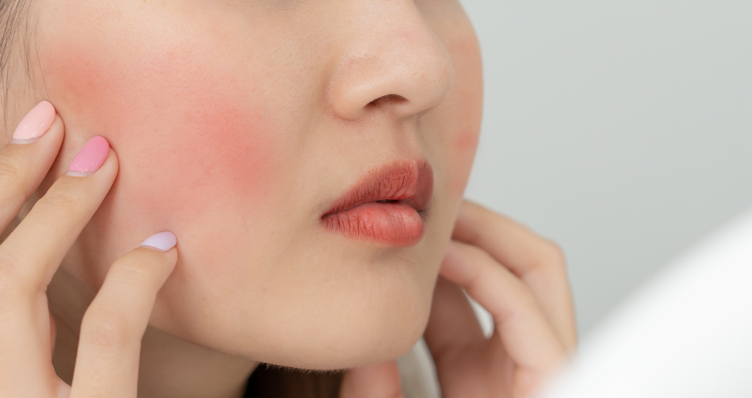 perbedaan rosacea dan jerawat