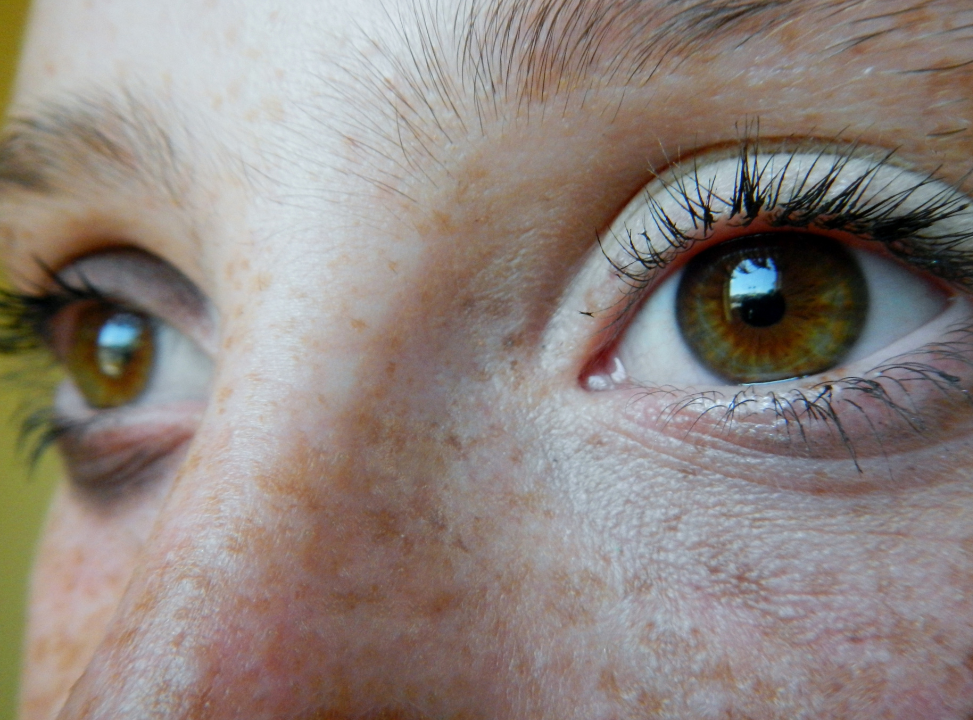 penyebab freckles bisa muncul