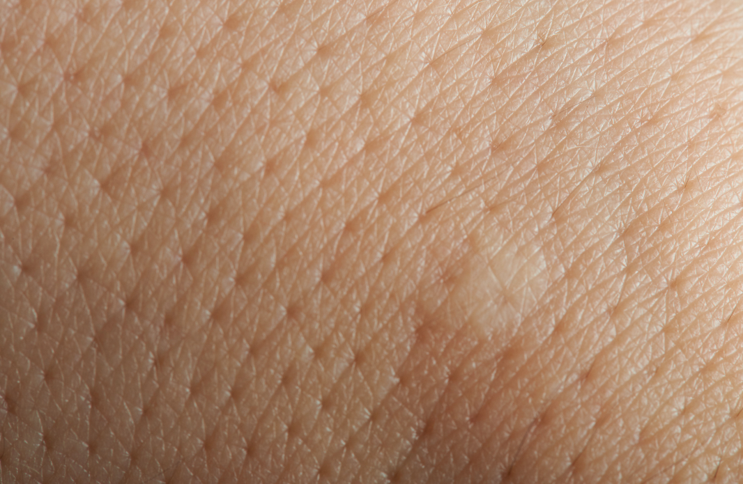 Mengapa Bisa Ada Ingrown Hair di Kulit?