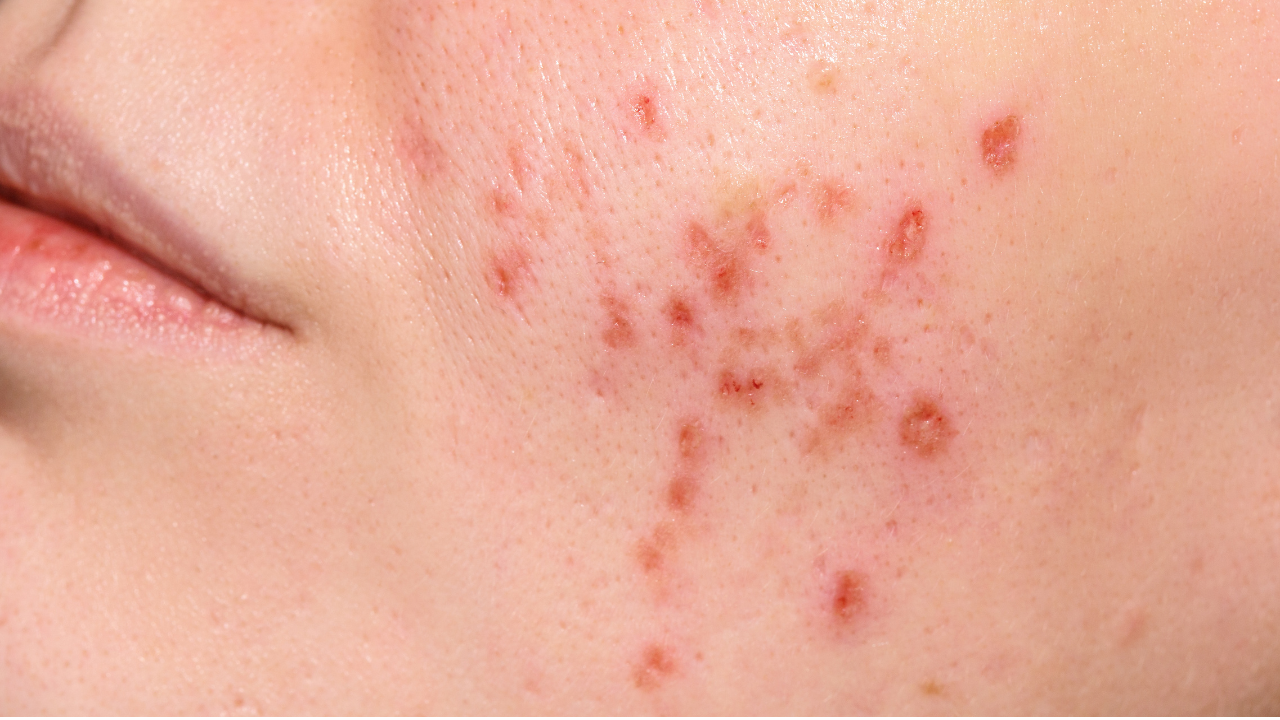 Ketahui Alasan Mengapa Skin Barrier Bisa Rusak