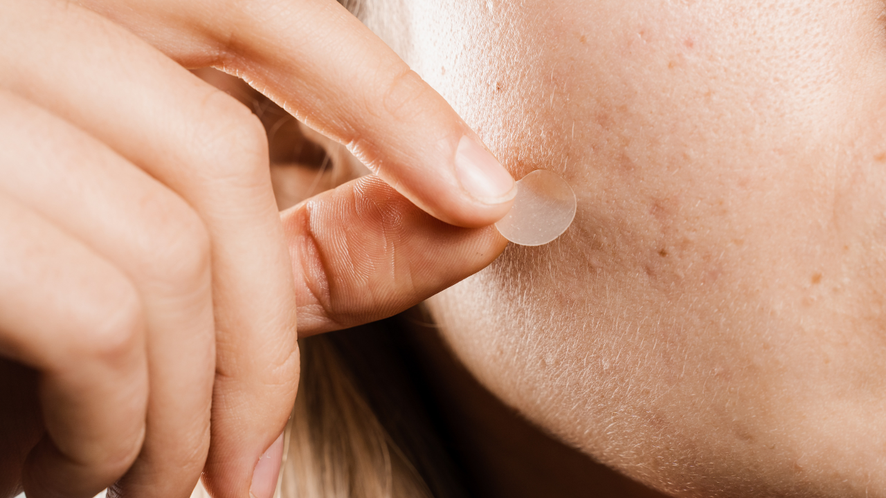 Acne Patch Bukan Sekadar Tren, Kenali Cara Kerjanya pada Jerawat